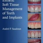Esthetic Soft Tissue Management of Teeth and Implants
