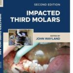 Impacted Third Molars